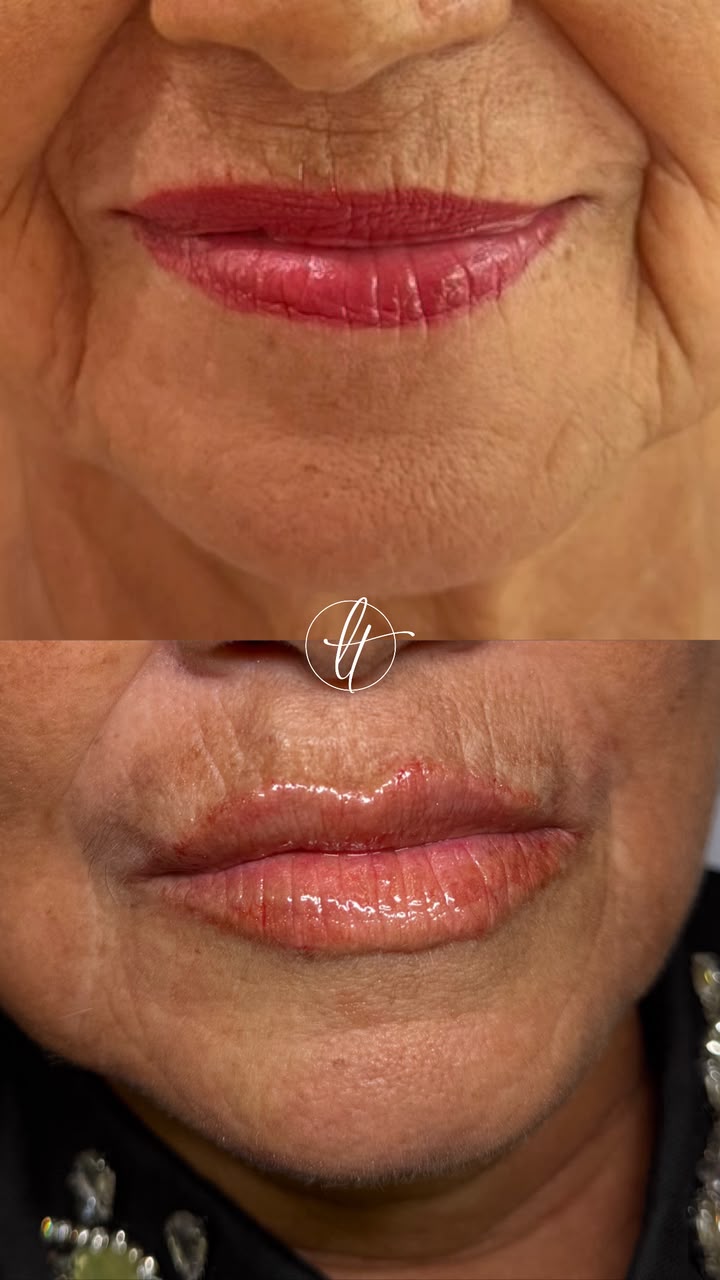Antes e depois de preenchimento labial