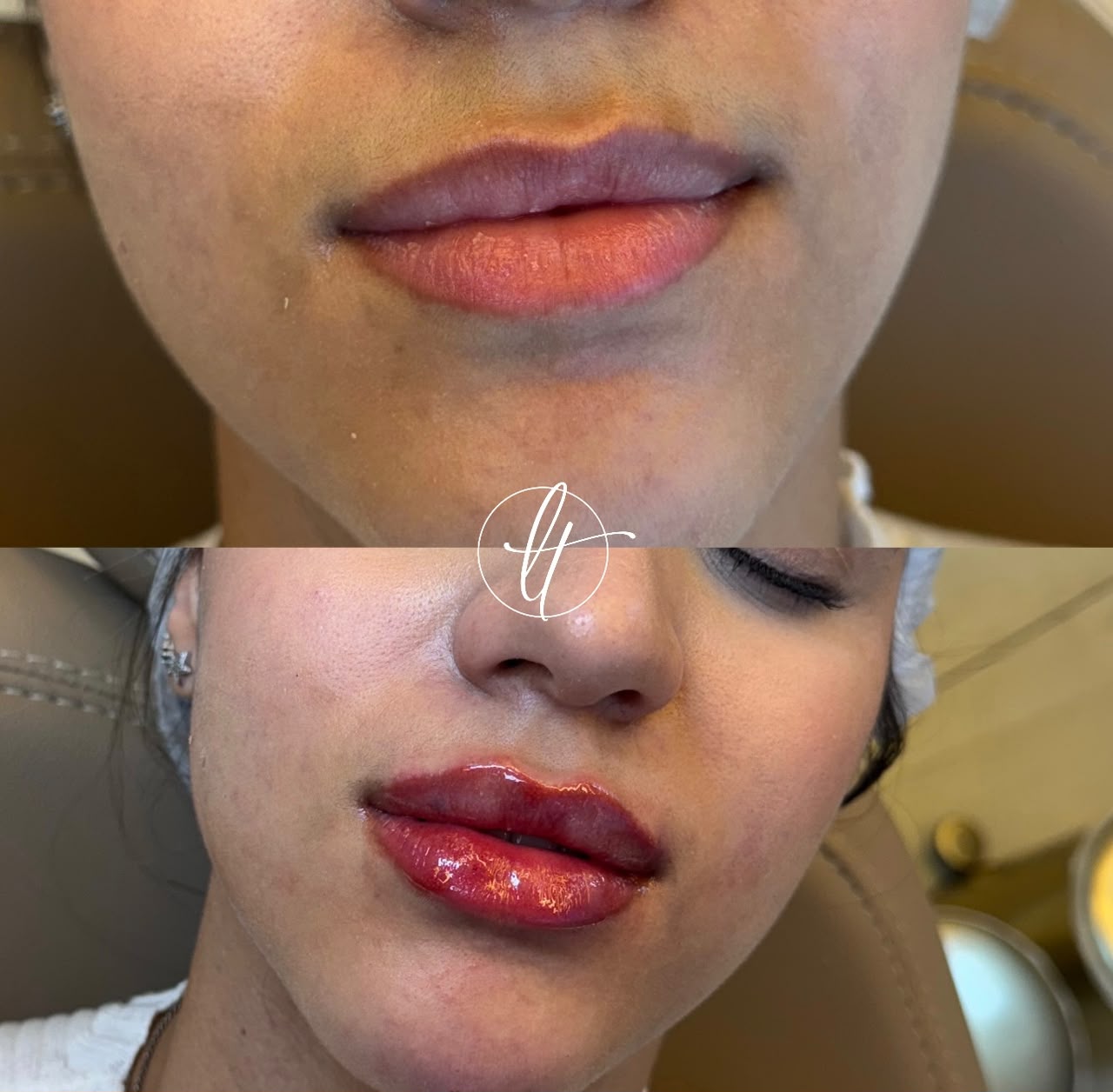 Caso clínico do Método Cherry Lips