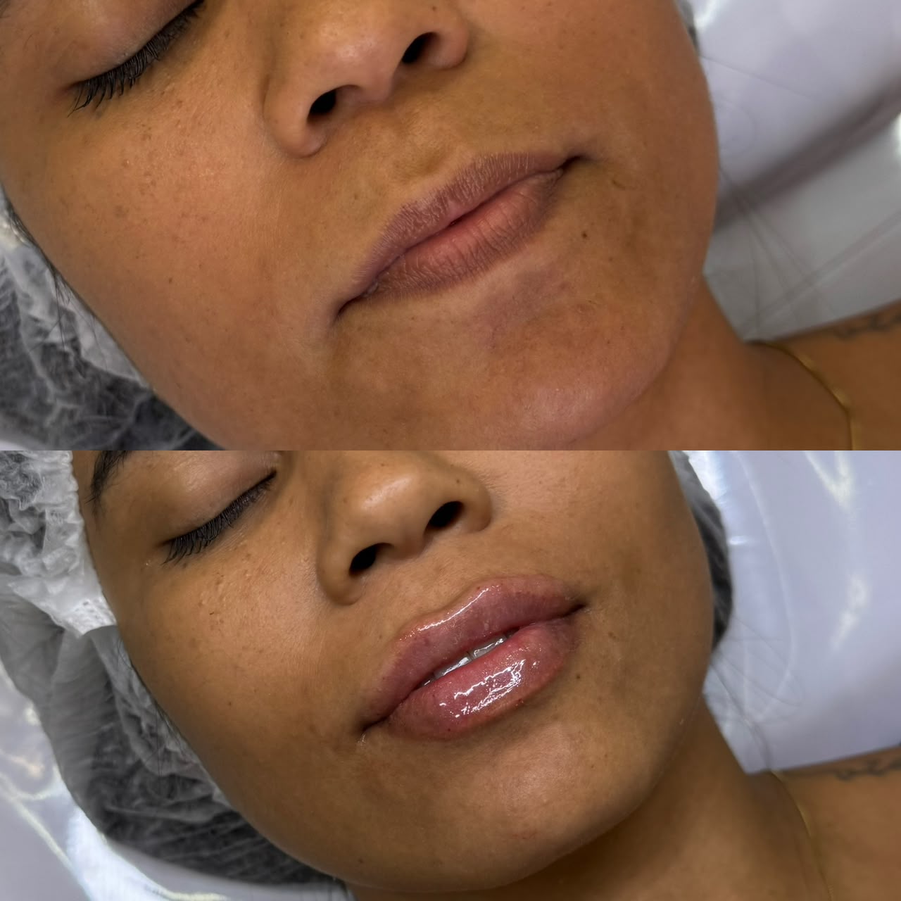 Antes e depois de preenchimento labial
